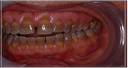 Before dental work