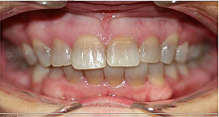Before dental work