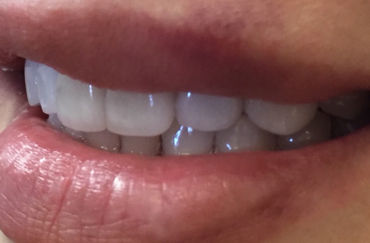 After dental work