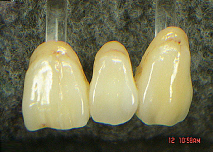 Before dental work